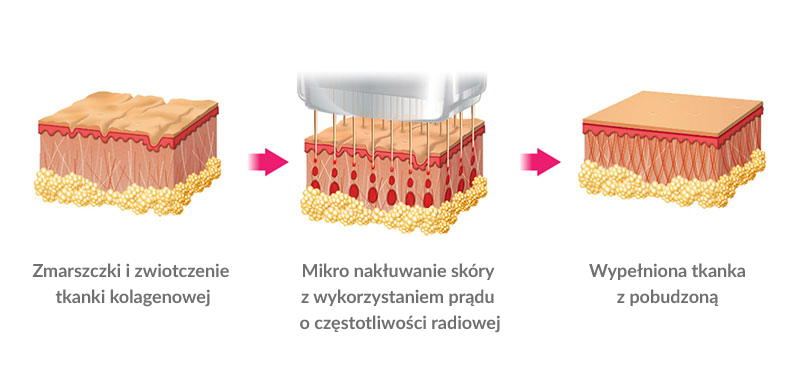 Jak działa radiofrekwencja mikroigłowa?